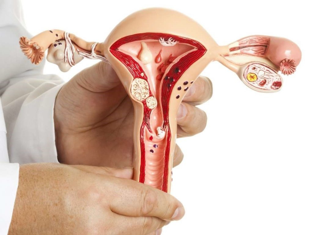Suy buồng trứng sớm