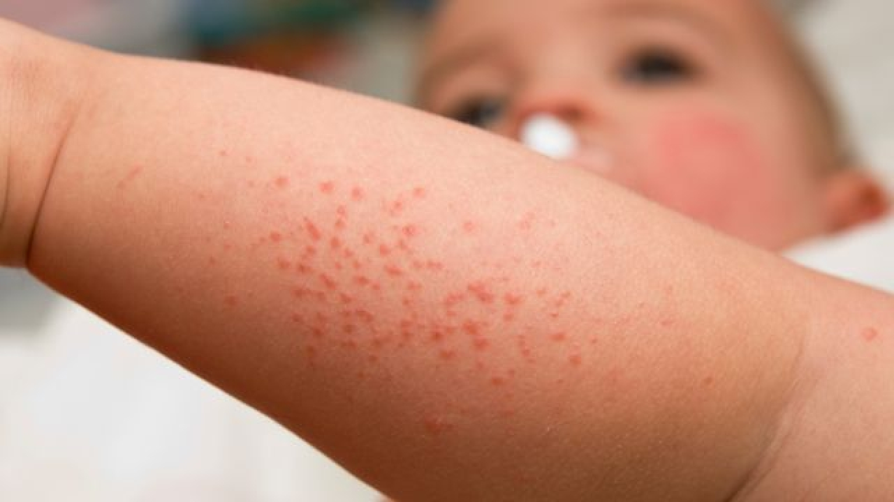 Chàm: Bệnh ngoài da gây mất thẩm mỹ, cần điều trị sớm và đúng cách