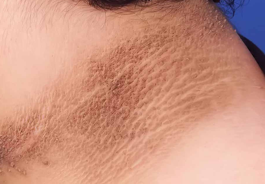 Gai đen là gì? Triệu chứng và cách điều trị gai đen