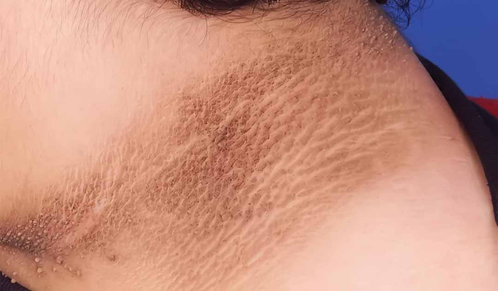 Gai đen là gì? Triệu chứng và cách điều trị gai đen