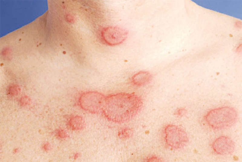 Lupus ban đỏ là gì? Nguyên nhân gây bệnh và nguyên tắc phòng ngừa