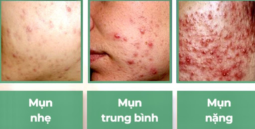 Mụn trứng cá