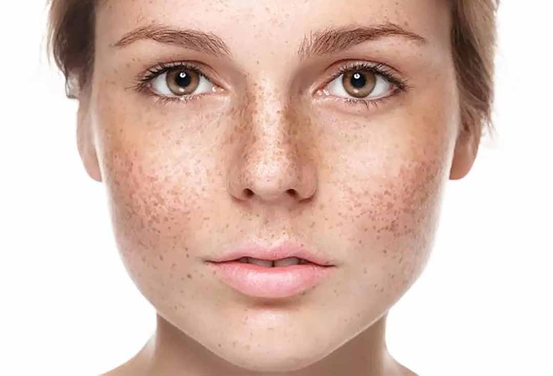Rám má là gì? Nguyên nhân gây bệnh, nguyên tắc phòng ngừa và điều trị
