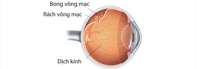 Bong võng mạc