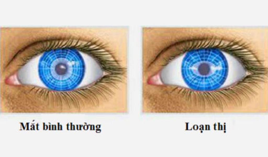 Loạn thị