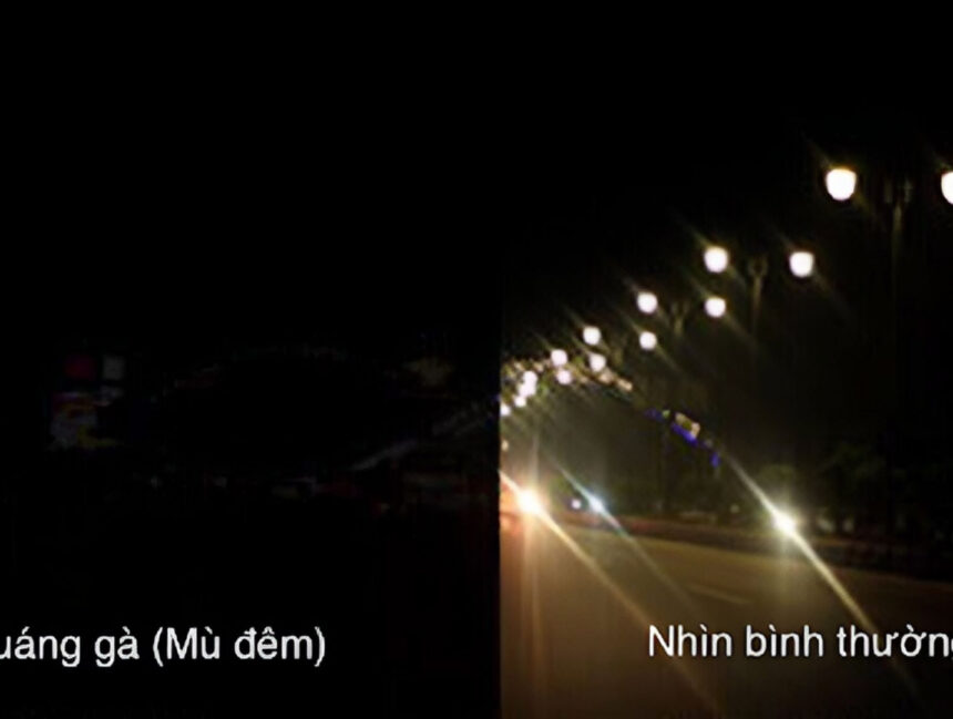 Quáng gà (chứng mù đêm): Bệnh lý thoái hóa sắc tố võng mạc mắt