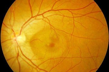 Tắc động mạch võng mạc trung tâm