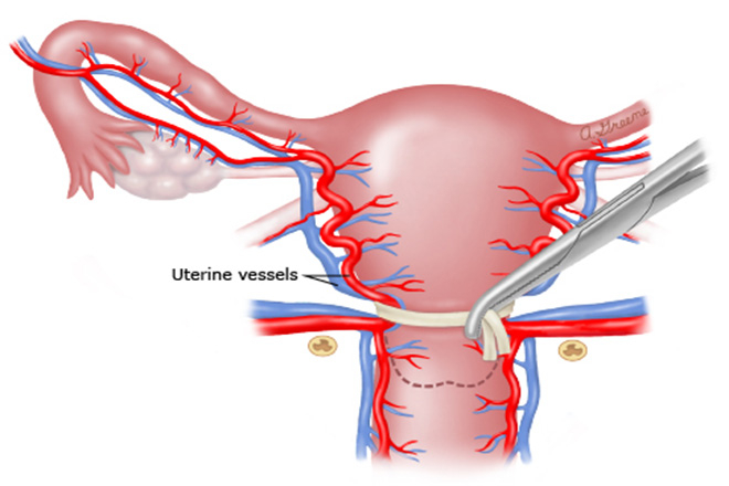 Băng huyết sau sinh