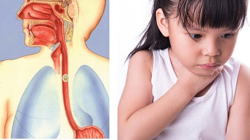 Dị vật đường thở