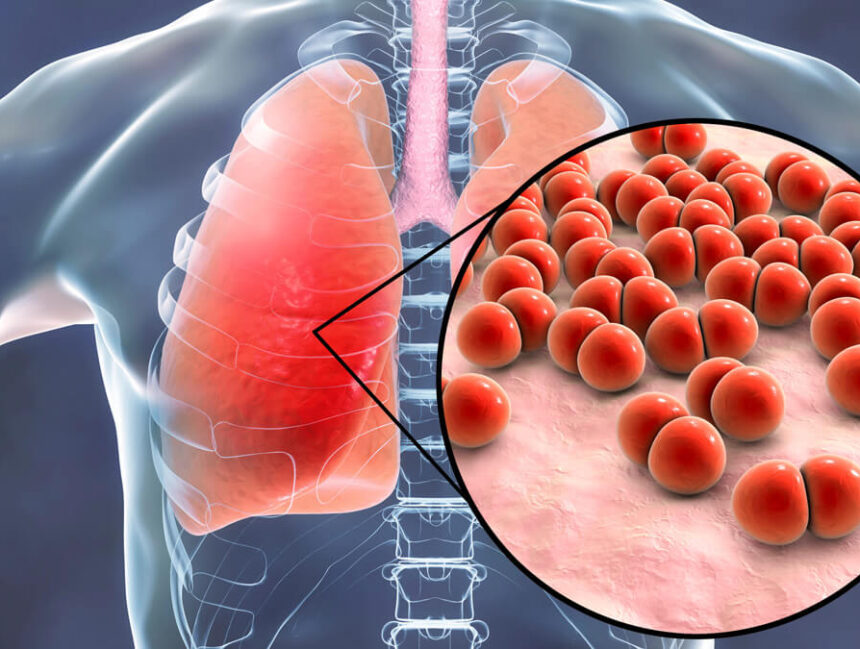 Bệnh phổi kẽ là gì? Nguyên nhân gây bệnh và nguyên tắc phòng ngừa