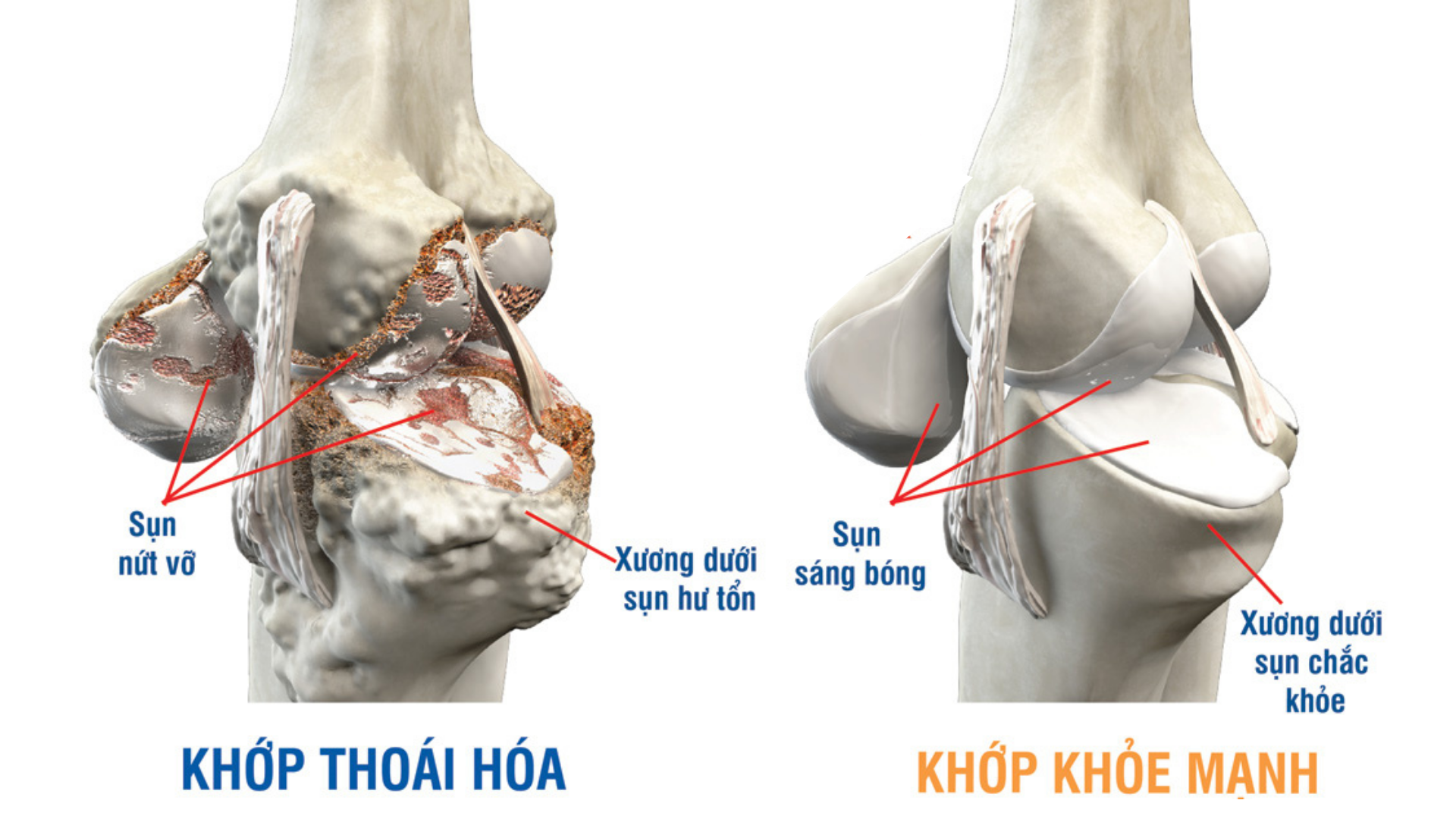 Thoái hóa khớp là gì? Nguyên nhân gây bệnh và nguyên tắc phòng ngừa
