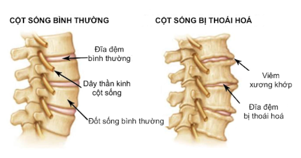 Thoái hóa đốt sống cổ
