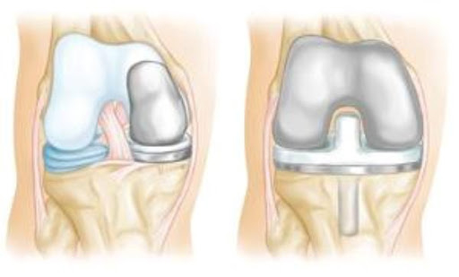 Thoái hóa khớp gối