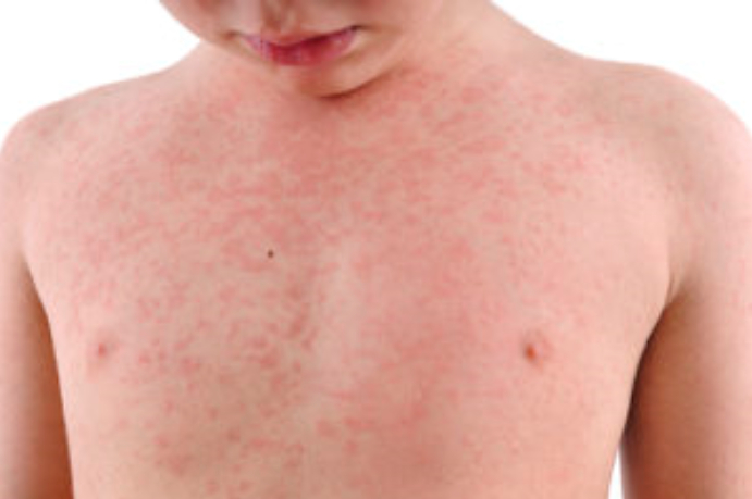 Rubella